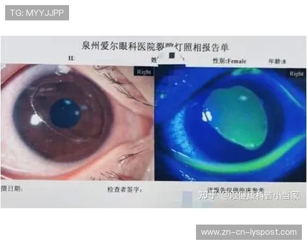 职业选手的“眼部健康”调查:长期专注屏幕对视网膜的损害有多大? 职业选手的“眼部健康”调查:长期专注屏幕对视网膜的损害有多大?